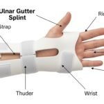 ulnar gutter splint