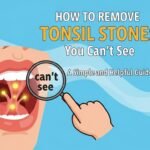 how to remove tonsil stones you can't see