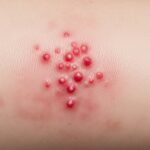 itchy bumps on skin like mosquito bites but aren't